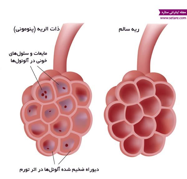 علائم عفونت ریه /انواع عفونت ریه